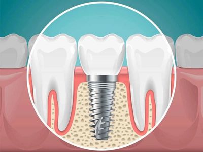 Diş implantı