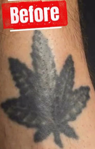 A faded black leaf tattoo on a person's arm labeled 'Before'.