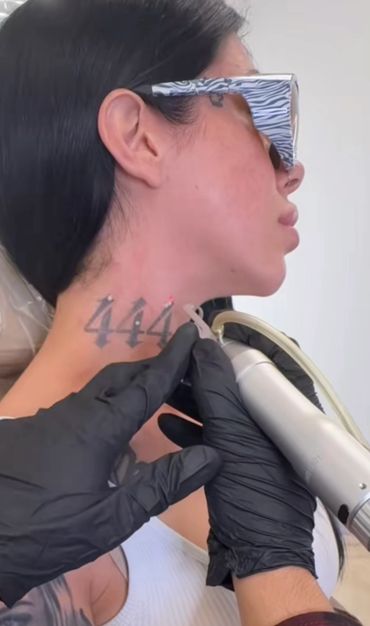 Person getting a 444 tattoo on their neck.