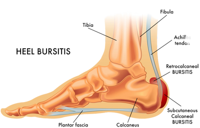 Subcutaneous achilles sale bursitis