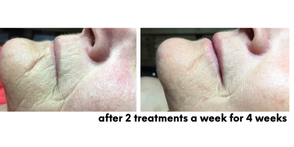 Before and after skin cream wrinkle treatment