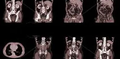 CT or CAT Scan