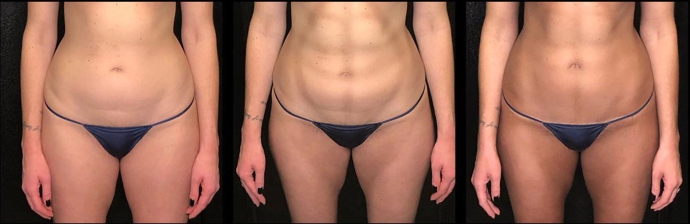 Sunless body contouring