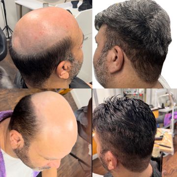 Before and after Hair Toupee
