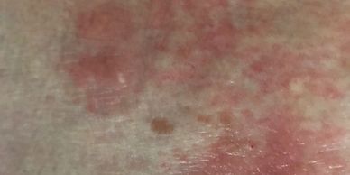 use acupuncture and herbal medicine to help rash