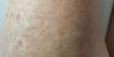 the rash disappeared after using our herbal cream