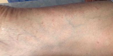 skin recovoered from eczema after using our herbal cream