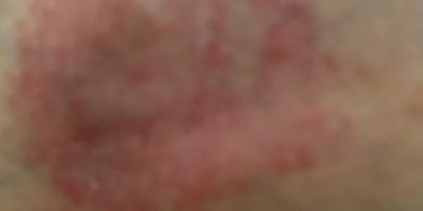 skin rash itch patches