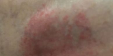 Eczema skin problems