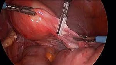 Laparoscopic Hysterectomy being performed