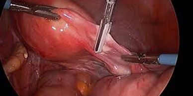 Laparoscopic Surgery