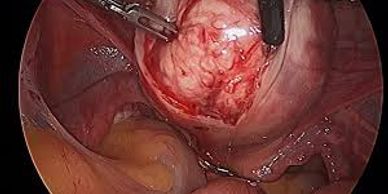 Uterine Fibroid laparoscopic surgery