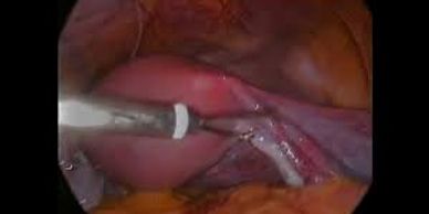 Laparoscopic Surgery