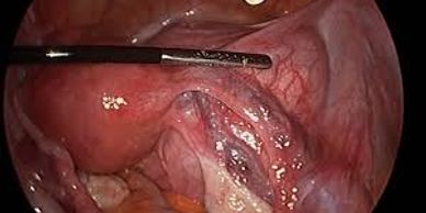 Hysterectomy Laparoscopically done for early cancer