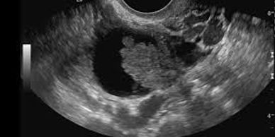 Ultrasound scan image of a malignant ovarian cyst