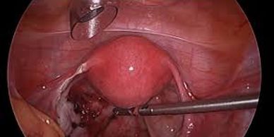 Left ovarian Cancer, Laparoscopic surgery