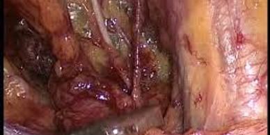 Pelvic node removal in Cervical Cancer, laproscopic Surgery