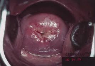 Early Cervical Cancer