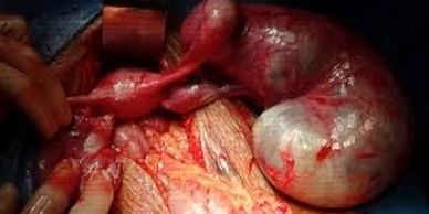 Dilated Right Fallopian tube with Cancer