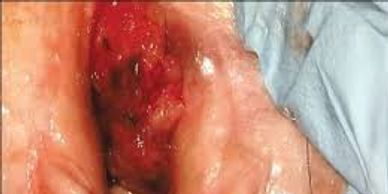 Vaginal Cancer