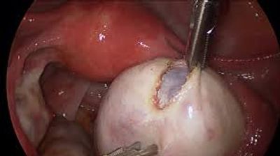 Laparoscopic Ovarian Cystectomy being performed