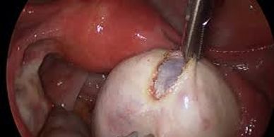 Ovarian Cystectomy, Laparoscopic Surgery