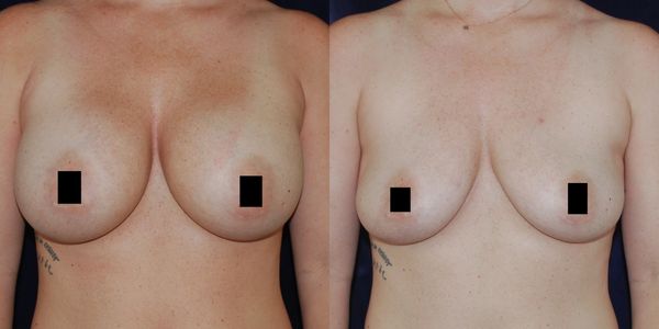 Before and after picture of breast implant removal.
