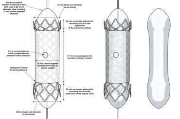 Custom CP heart stent for Helen Devos Children Hospital