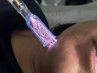Plasma Fibroblast Therapy can naturally heal skin pigmentation, scars, and other skin texture issues