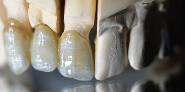 Bridge manufactured by DW Dental Lab 