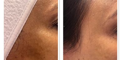 what does a hydro facial do?