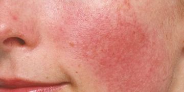 rosacea pelle sensibile sensitive and intolerant skin couperose
