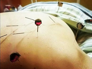 a patient receiving acupuncture and moxibustion