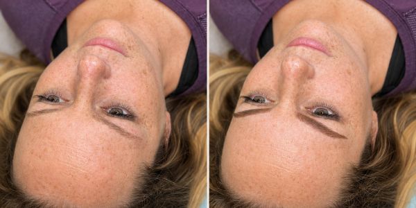 Before and after eyebrow enhancement on a woman’s face.