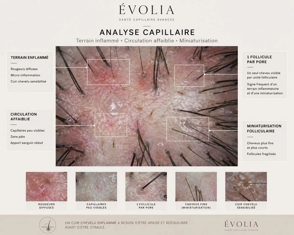 Close-up scalp analysis showing inflammation, weakened circulation, and miniaturized hair follicles.