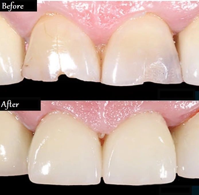 Bonding & White Fillings, Dentist in Phoenix, AZ