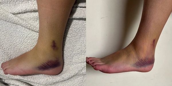 Before and after Cold Therapy Unit III