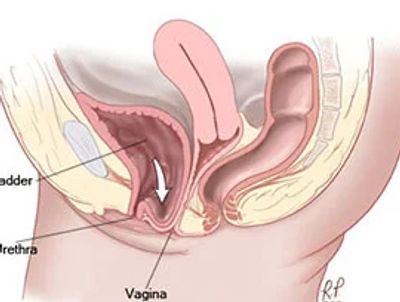 Anterior vaginal prolapse (Cystocele) - Vejthani Hospital