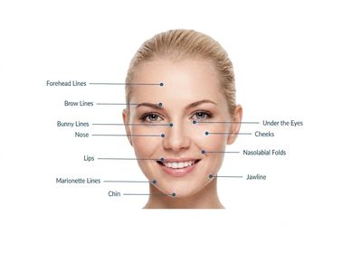 dermal fillers, lip fillers, cheek fillers somerset, taunton, devon, Cornwall, dorset, Exeter. 