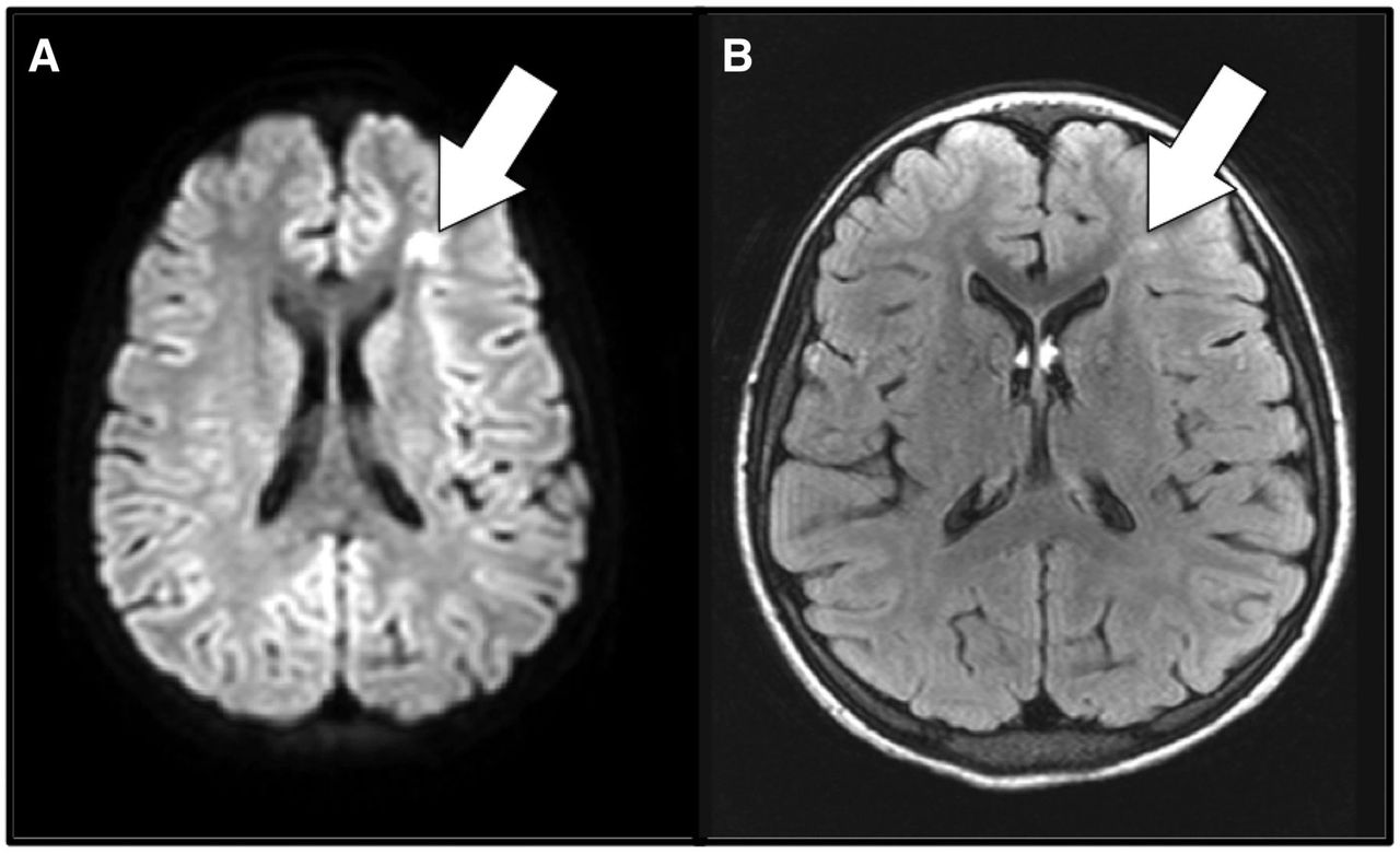 Infarto cerebral en un paciente con anemia drepanocítica