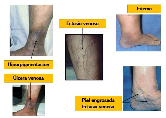 La tratamiento venosa crónica úlcera de