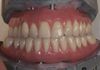 Nice Esthetics and Hygiene function in dual arch case