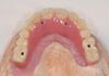 Completed Conversion of Denture to Screw Retained Provisional