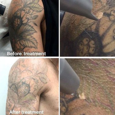 Results after second treatment