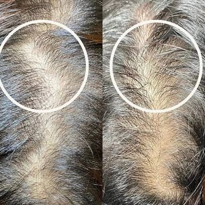 Results after x1 treatment
