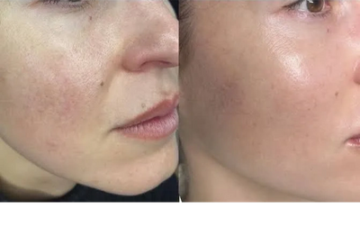 Results after x2 Revlite treatments