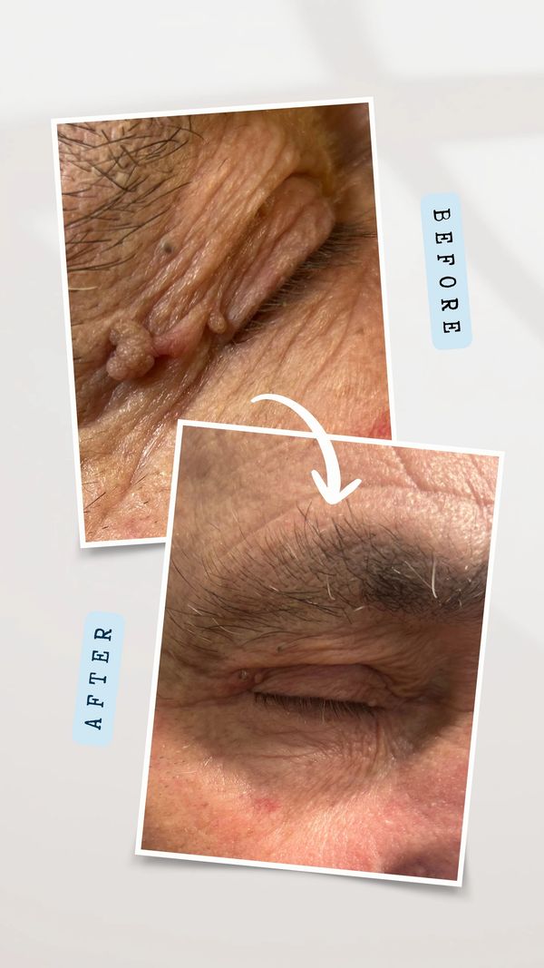 Large skin tag removed from eyelid 