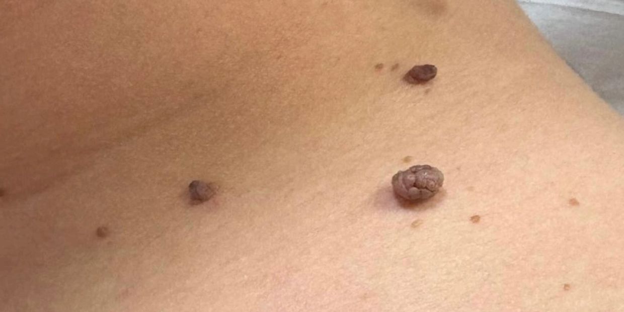 Instant SKIN tag removal hawarden, Deeside, wirral, Liverpool, chester, affordable, safe