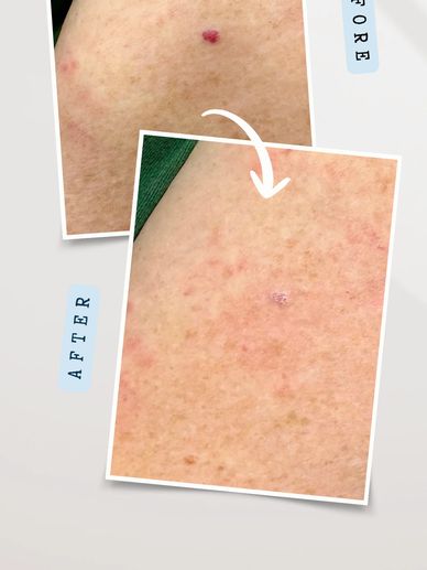 Cherry angioma removal treatment for red skin lesions on the arm in flintshire
