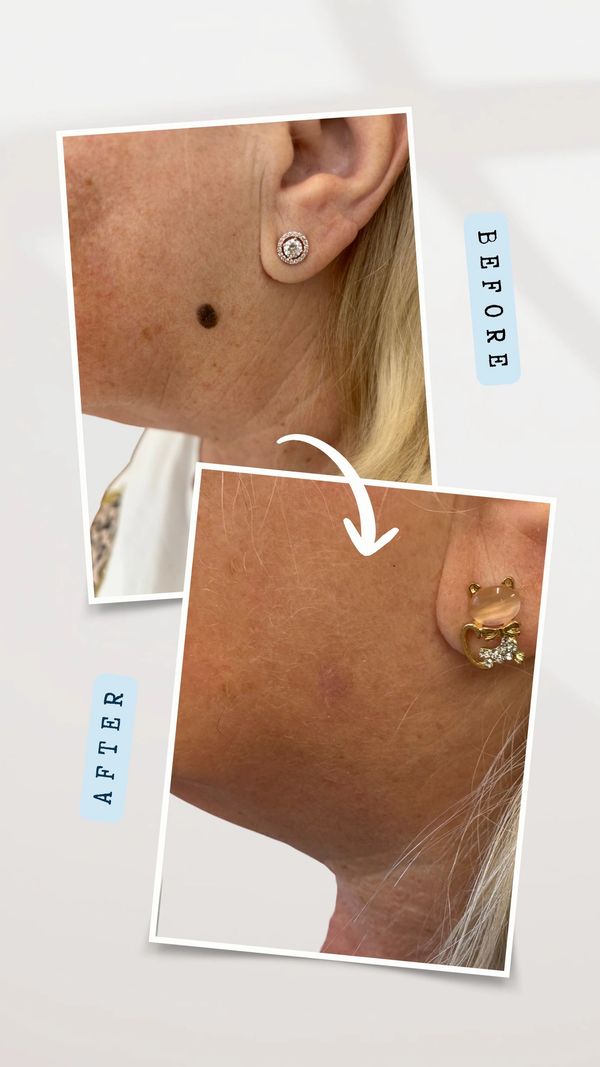 seborrhoea keratosis removed in one treatment session